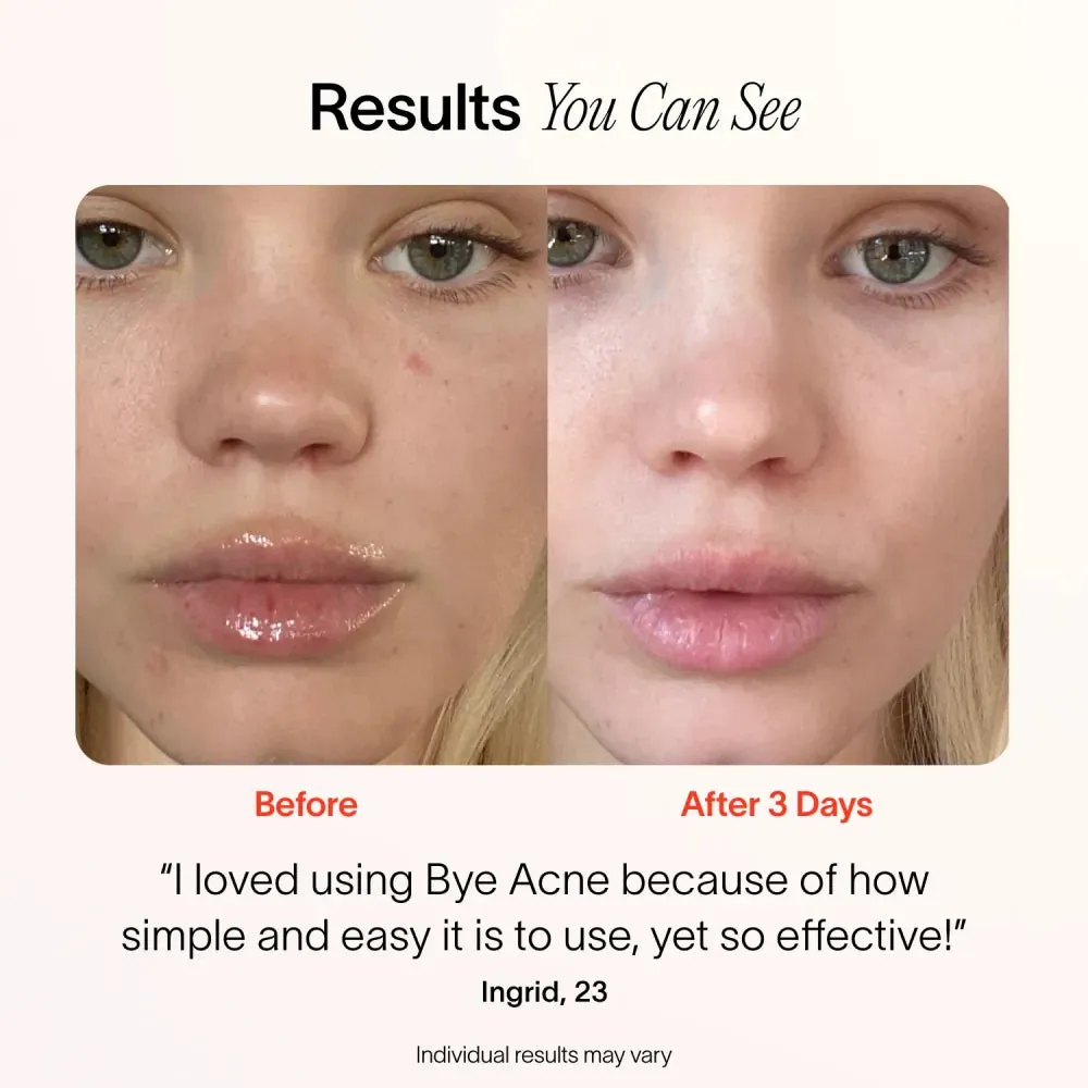 Bye Acne: 3-Minute Pimple Spot Treatment